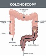 Image result for Colon Location by Cm