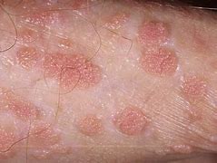 Image result for CDC Condyloma