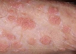Image result for Human Condyloma