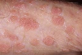 Image result for Condyloma Causes