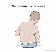Image result for Neuromuscular Scoliosis