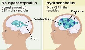 Image result for Hydranencephaly vs Hydrocephalus
