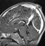 Image result for Parietal Encephalocele