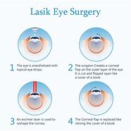 Image result for After Lasik Surgery