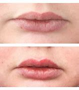 Image result for Juvederm Lip Filler