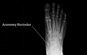 Image result for Accessory Navicular Bone