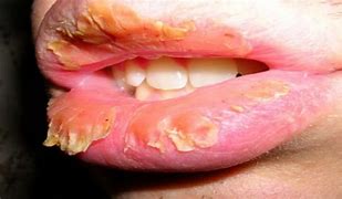 Image result for Severely Chapped Lips