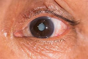Image result for Cataract