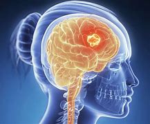 Image result for Head Tumor