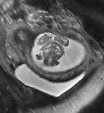 Image result for Anencephaly Radiolog MRI