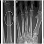 Image result for Foot Bones X-ray