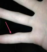 Image result for Cell Phone Pinky Finger Deformity
