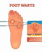 Image result for Different Warts On Feet