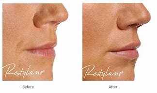 Image result for Juvederm Lips Before and After
