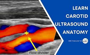 Image result for Carotid Artery Scan