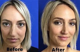 Image result for Filler for Lines around Mouth