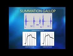 Image result for Gallop Rhythm Cardiology