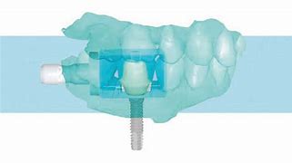 Image result for CAD/CAM Dentures