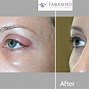 Image result for Eyelid Wart Removal Surgery