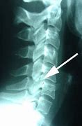 Image result for Anterior Subluxation Cervical Spine