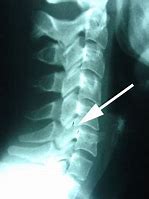 Image result for Cervical Spine Subluxation