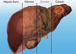 Image result for cirrosis