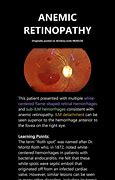 Image result for Anemia Retinopathy