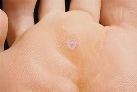 Image result for Plantar Wart On Finger Removal