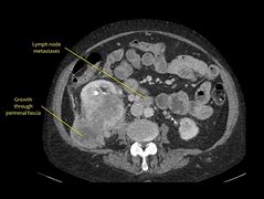 Image result for 2 Cm Mass On Kidney