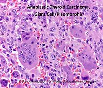 Image result for Anaplastic Thyroid Cancer Ultrasound