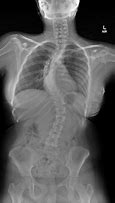 Image result for Cervical Spine Scoliosis