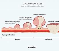 Image result for Risk Colon Polyp Size