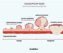 Image result for Types of Colon Polyps Adenomas