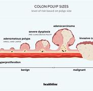 Image result for Colon Polyps Size