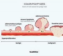 Image result for Colon Polyps Size Chart