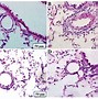 Image result for Pulmonary Artery Remodeling