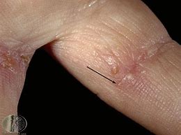 Image result for What Does Scabies Look Like