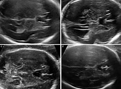 Image result for CSP Fetal Ultrasound