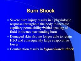Image result for Burn Shock