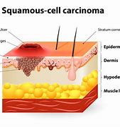 Image result for Basal Cell Carcinoma Diagram