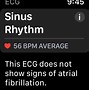 Image result for Apple Watch ECG Atrial Fibrillation