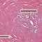 Image result for Adenomyosis