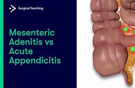 Image result for adenifis