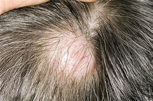 Image result for Cyst On Head Scalp
