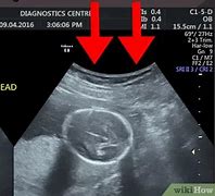 Image result for USG Interpretation iOS Chart