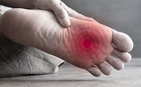 Image result for Diabetic Foot Infections Cellulitis