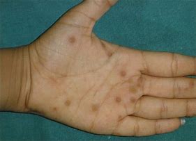 Image result for Palm Warts