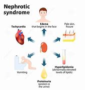 Image result for Nephritic Syndrome