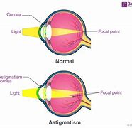 Image result for What Does Astigmatism Vision Look Like