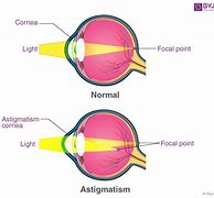 Image result for Astigmatism Cross Eye